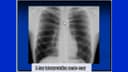 Chest X-Ray Interpretation: Step-by-Step Guide for Medical Professionals