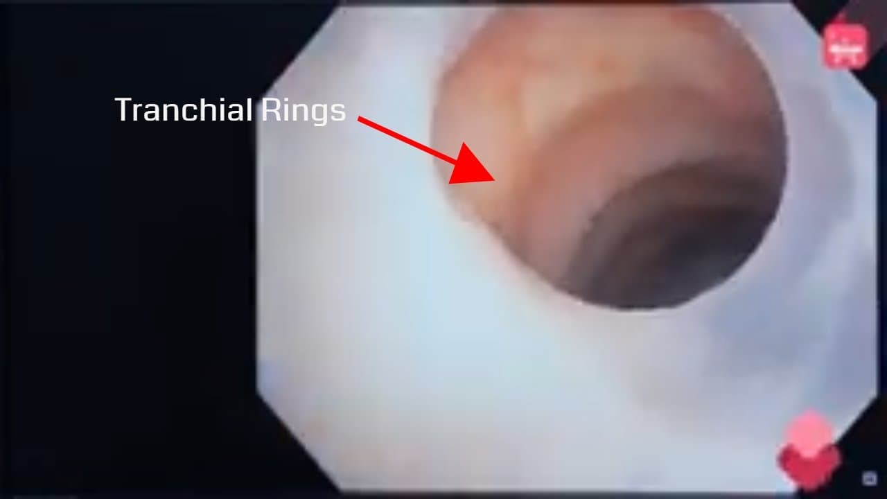 Real #Brochoscopy procedure : How its done?