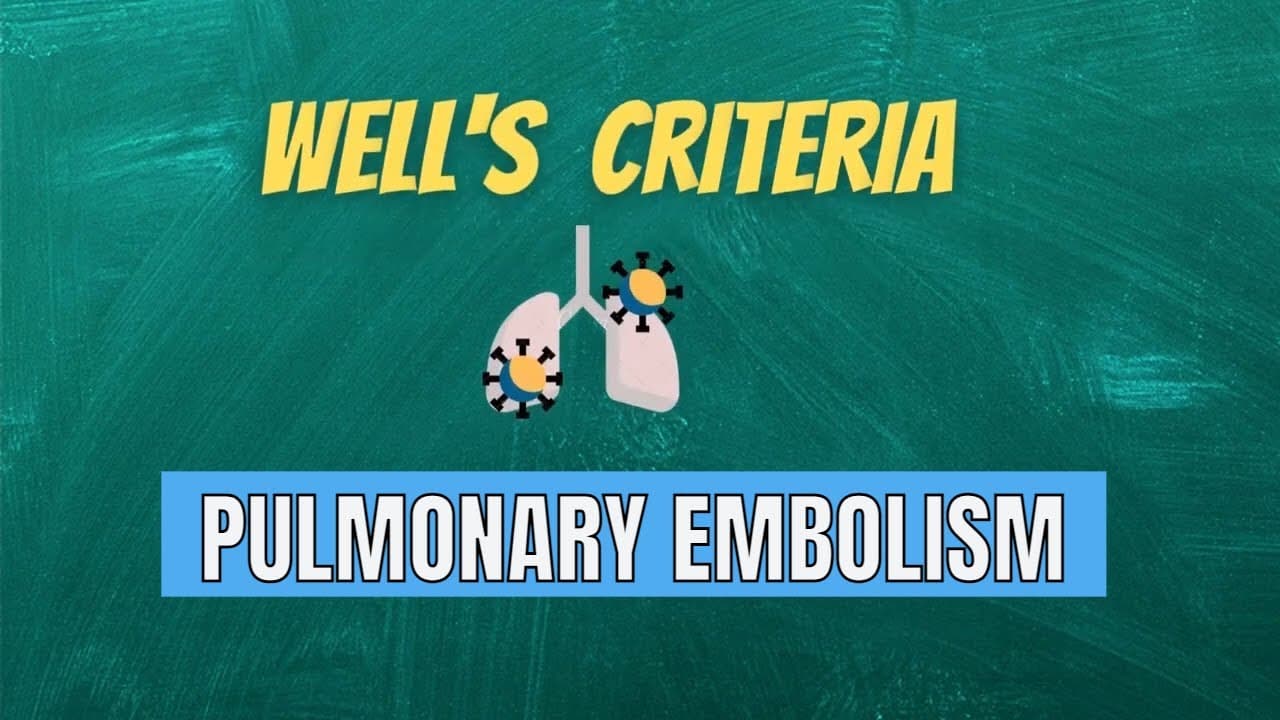 Wells criteria to rule out Pulmonary Embolism