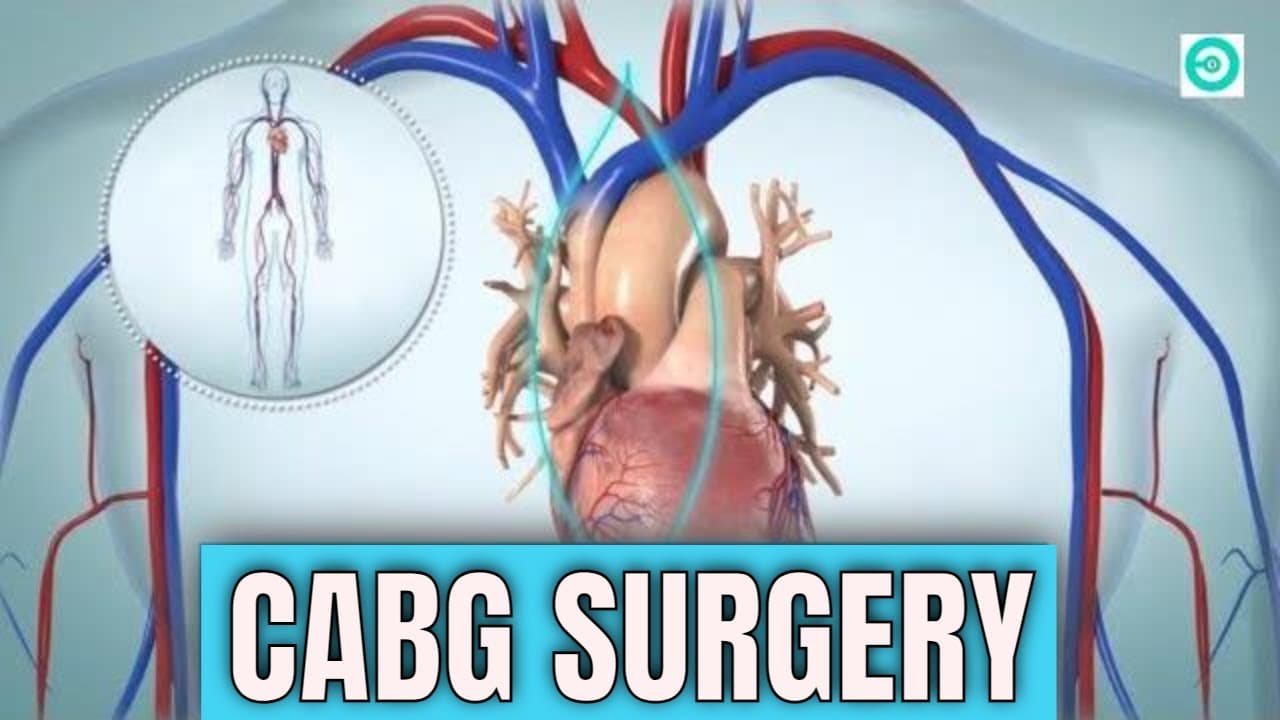 CABG (coronary artery bypass graft): Open Heart Surgery